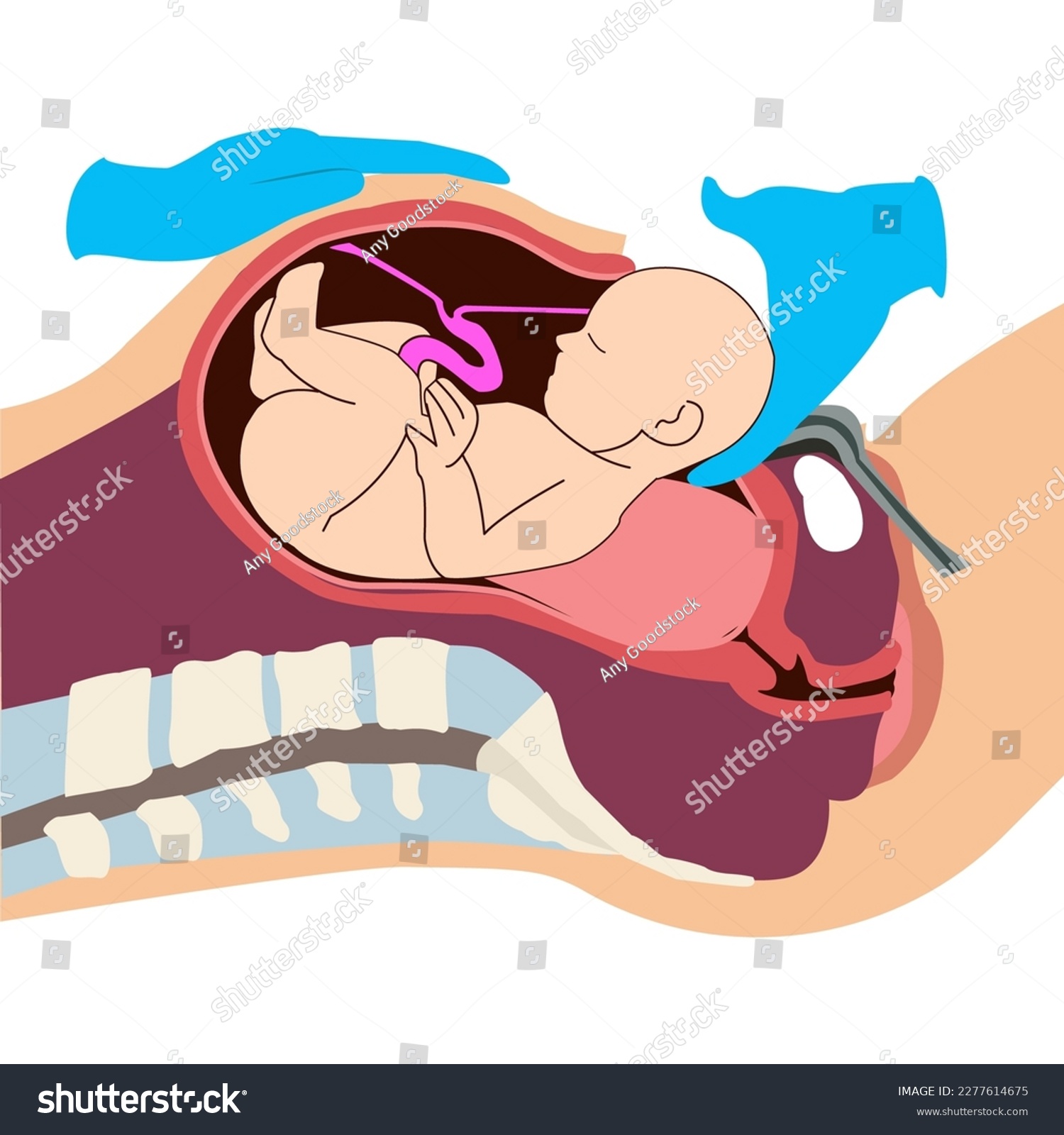 Cesarean Section (C-Section) - Specialist Gynaecology Treatment in Bangalore